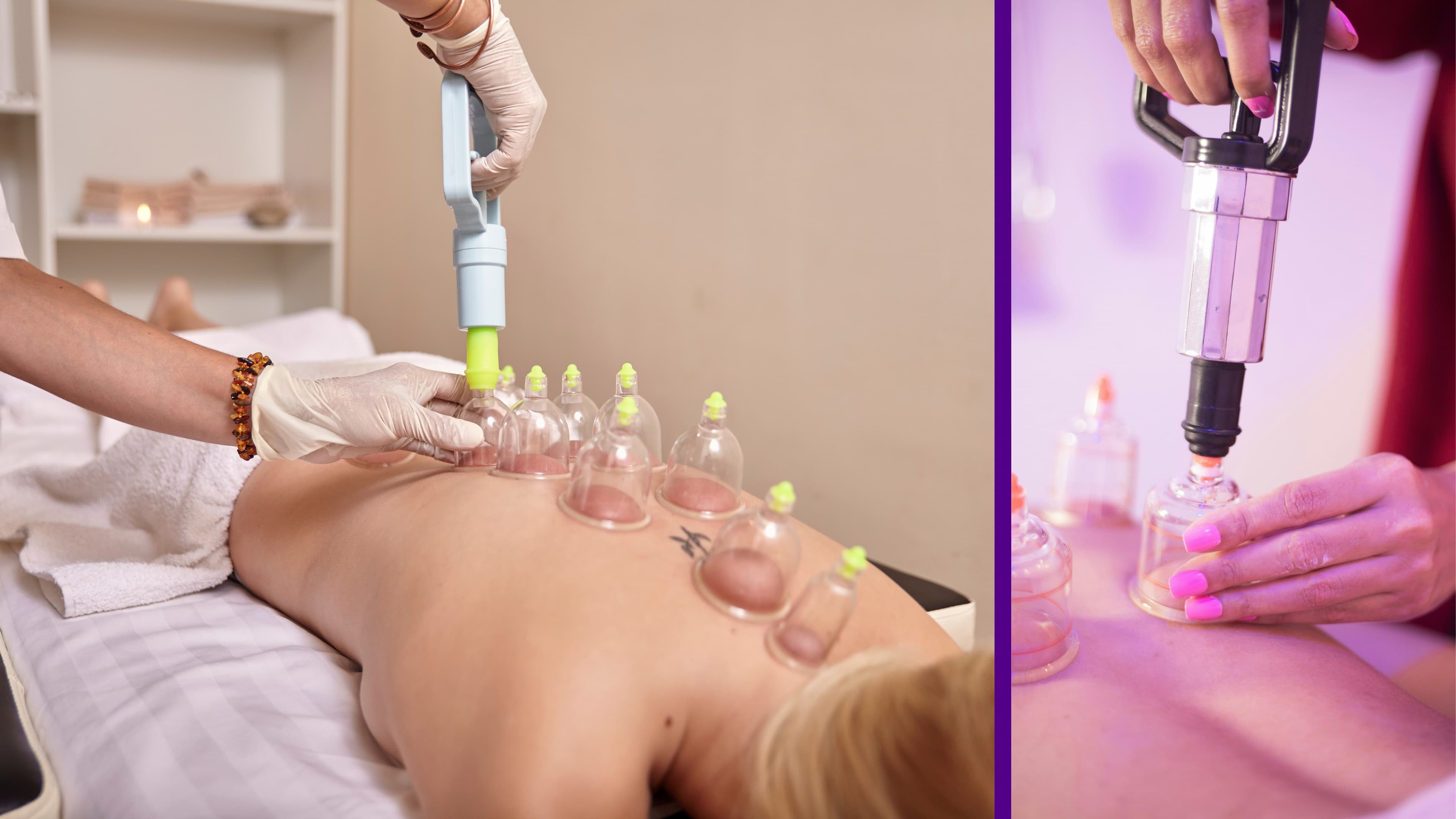cupping-therapy
