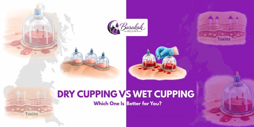 https://api.barakahhijama.com/aritcles/dry-cupping-vs-wet-cupping-which-one-is-better-for-you-1.jpg