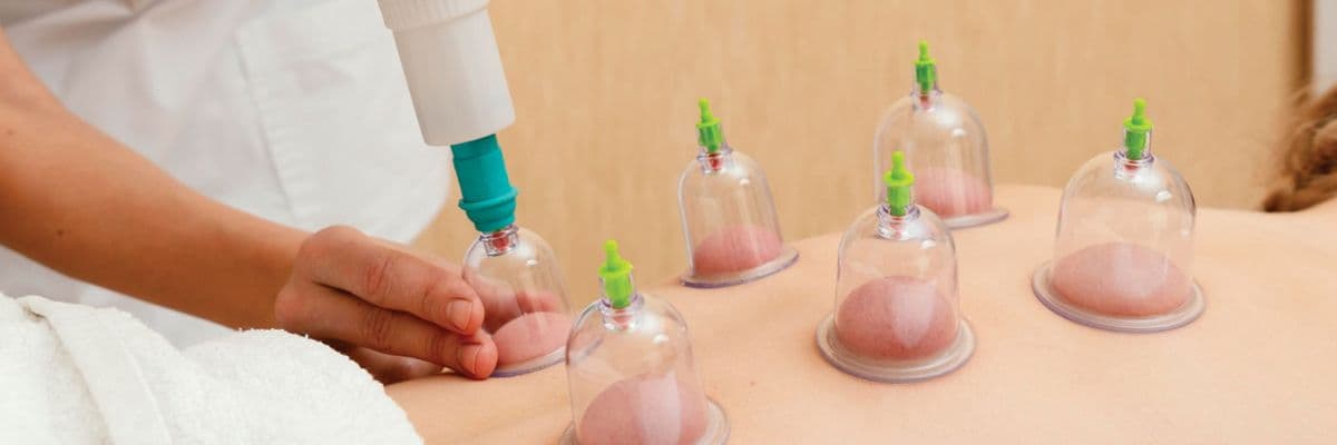 Hijama with Cupping