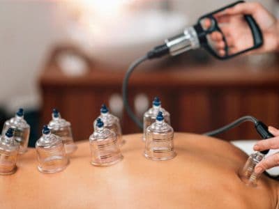 Hijama with Cupping